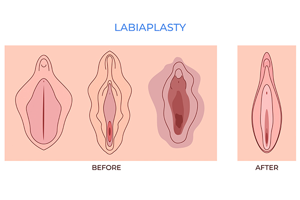 Representación cirugía labioplastia para corregir hipertrofia vaginal