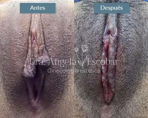 Img-Dra-Angela-Procedimiento-Labioplastia-22