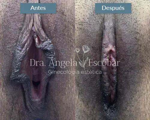 Img-Dra-Angela-Procedimiento-Labioplastia-23