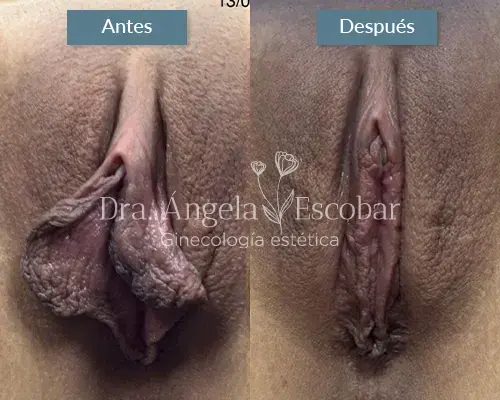 Img-Dra-Angela-Procedimiento-Labioplastia-25