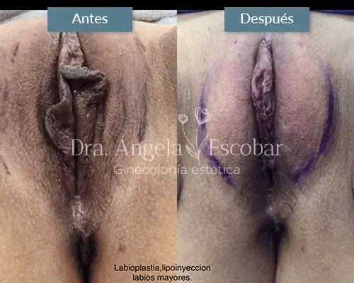 Img-Dra-Angela-Procedimiento-Labioplastia-26