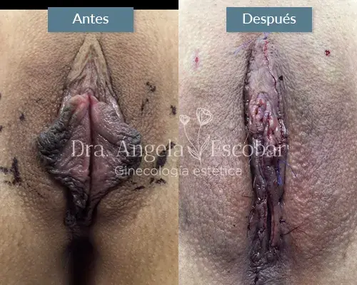 Img-Dra-Angela-Procedimiento-Labioplastia-27