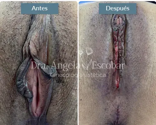 Img-Dra-Angela-Procedimiento-Labioplastia-28