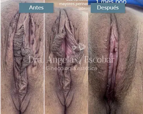 Img-Dra-Angela-Procedimiento-Labioplastia-Perineoplastia-17